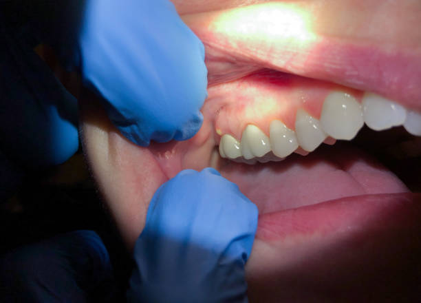 Best Emergency Tooth Extraction in Hilliard, FL